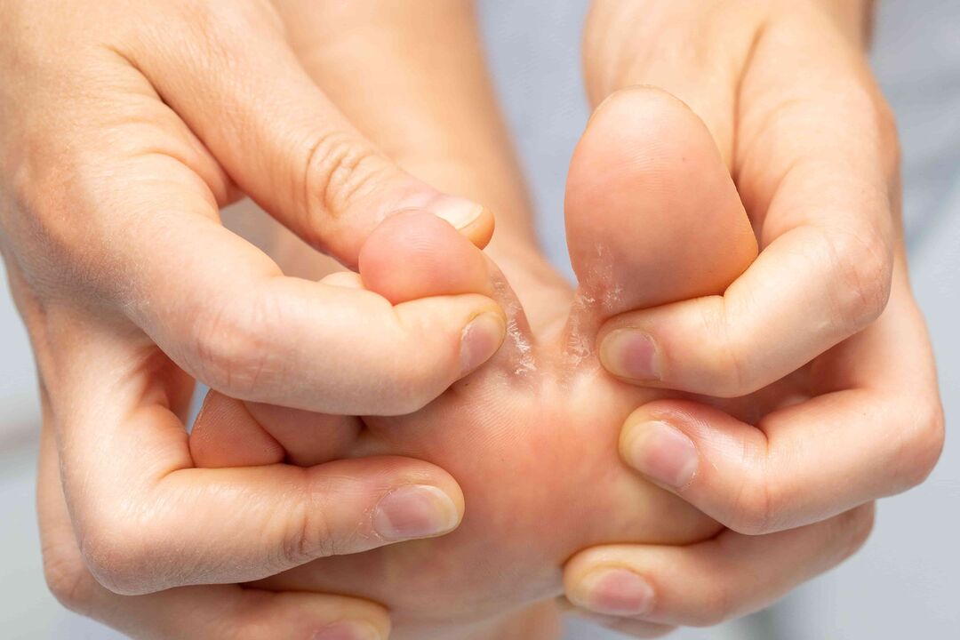 Fungo tra le dita dei piedi e il suo trattamento con zxcvbnmqwert -cream