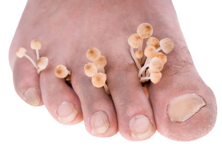 Fungo sopra i sintomi delle gambe
